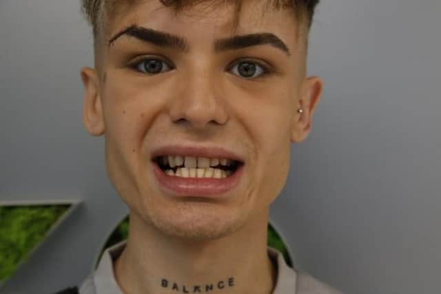 Jack's teeth before he had the veneers in Turkey