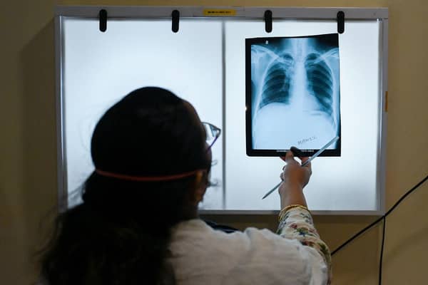 Tuberculosis (TB) cases in England have increased by 13%.