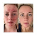 Abigail's results 47 Skin 