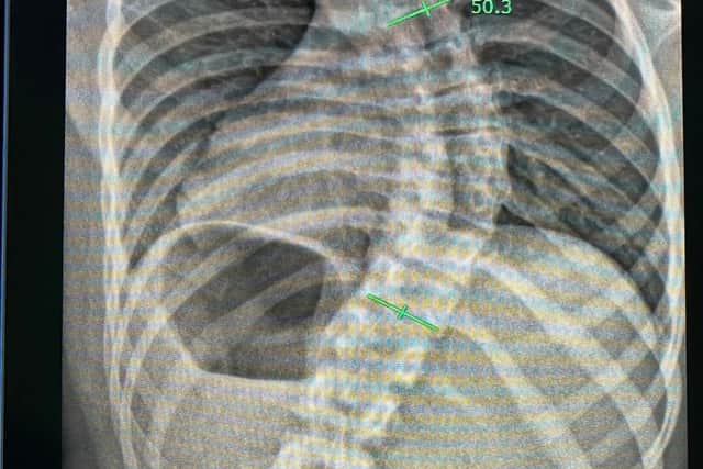An X-Ray showing the curve in Mia's spine.