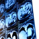 Harrogate charity's boost for diagnosing - The scans will be provided alongside lung health checks to help save lives. (Picture contributed)