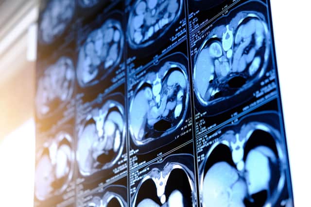 Harrogate charity's boost for diagnosing - The scans will be provided alongside lung health checks to help save lives. (Picture contributed)