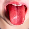 Tongue of a child with scarlet fever - strawberry tongue.