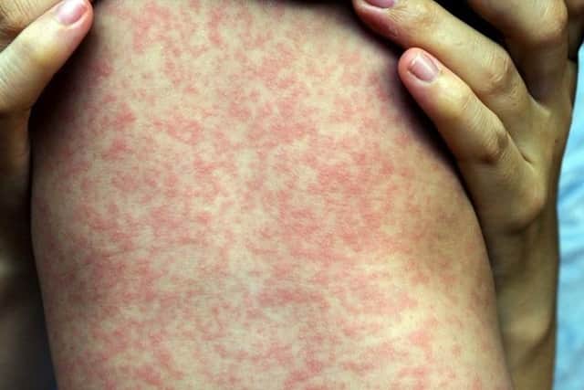 A child with measles.Credit - NHS Inform
