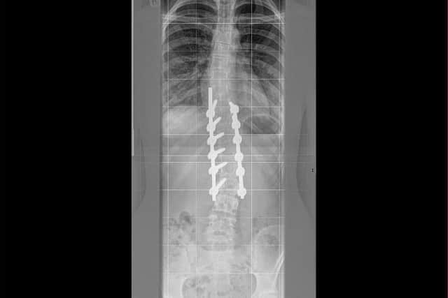 X-ray after Phoebe's surgery. Credit: Nuffield Health Leeds Hospital