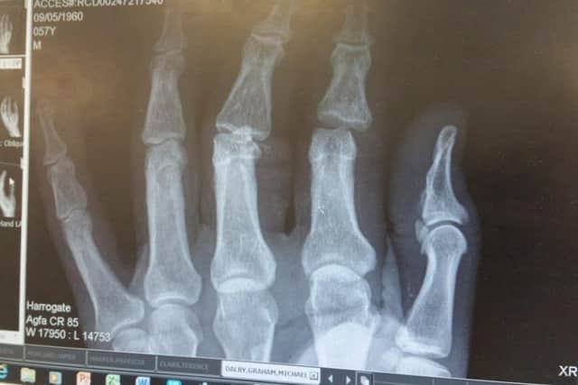 He badly dislocated two of his fingers on his left hand in the accident